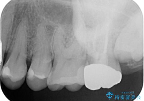 虫歯をセラミックで治療の治療後