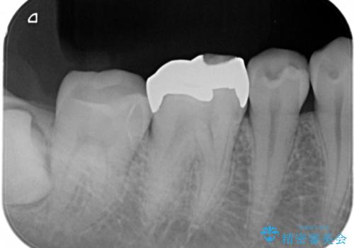 銀歯をセラミックにの治療前