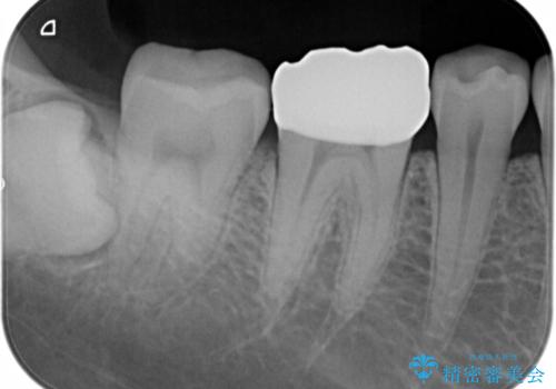 銀歯をセラミックにの治療後