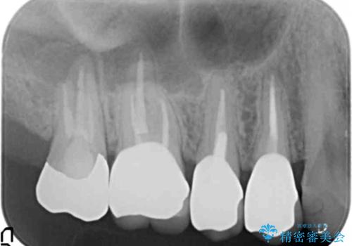 精度の高いセラミッククラウンの治療後