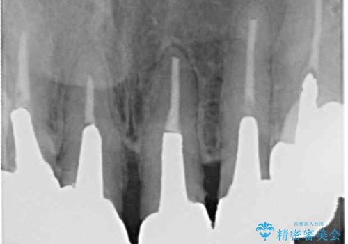 汚れてしまった保険のクラウン 前歯のオールセラミックの治療前