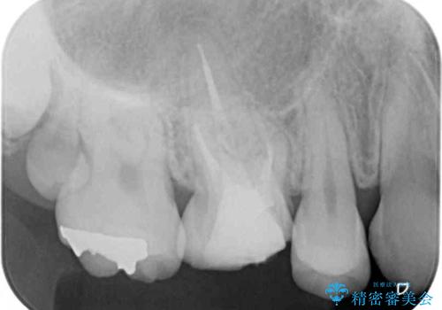 変色した前歯 オーダーメイドタイプのオールセラミッククラウンの治療前