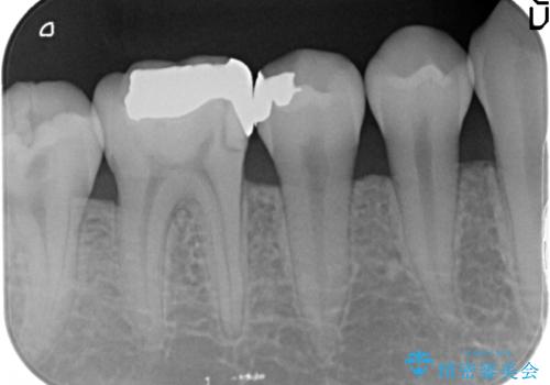 歯の神経を残す、丁寧な虫歯の除去の治療前
