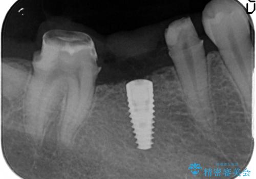 臼歯インプラント補綴の治療中