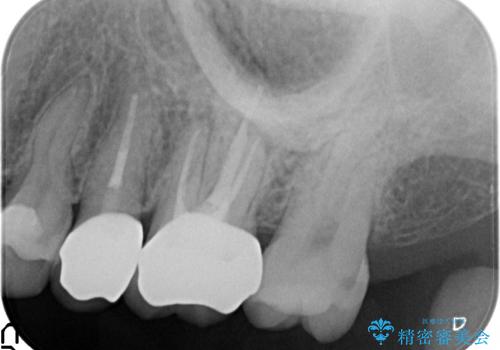 オールセラミッククラウン 痛みが治まらない歯の治療の治療後