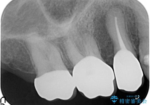 オールセラミッククラウン しみる歯の治療の治療後