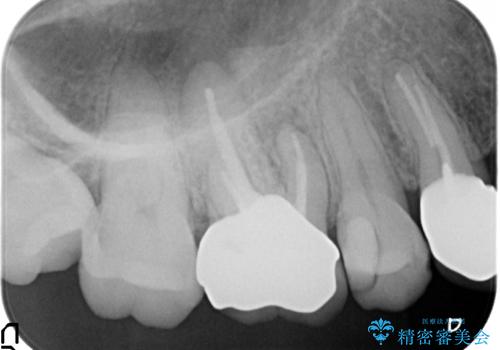 オールセラミッククラウン 他院にて治療困難と言われた歯の治療の治療後