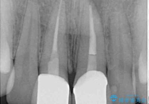 変色した前歯のオールセラミック治療の治療後