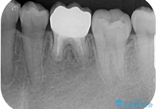 前歯のデコボコを治したい ワイヤー矯正の治療後