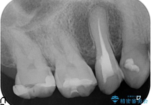 オールセラミッククラウン しみる歯の治療の治療前