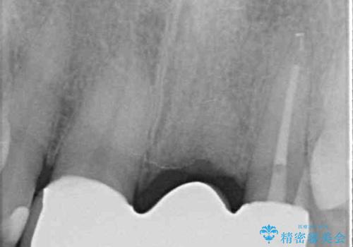 不自然な前歯のブリッジをオールセラミックできれいにの治療後
