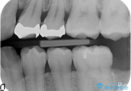 近所で入れた銀歯に食べ物が挟まるの治療前