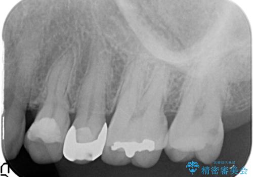 オールセラミッククラウン 痛みが治まらない歯の治療の治療前