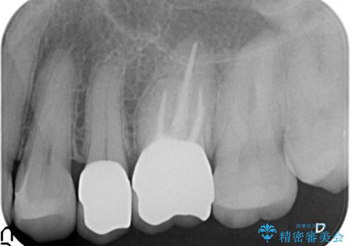 オールセラミッククラウン セラミックインレー 銀歯を白い歯への治療後