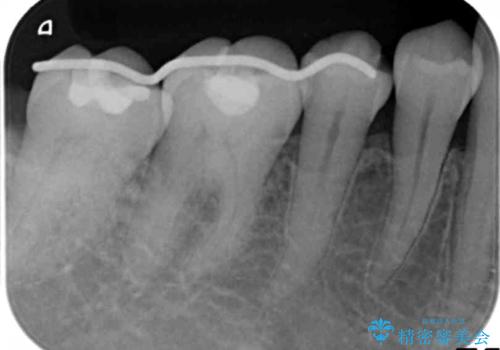 歯周病 再生治療で歯を残すの治療中