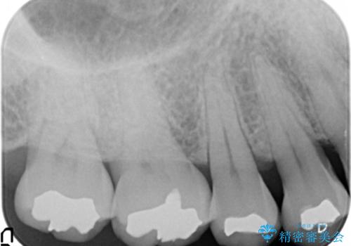 銀歯の引っかかり　化学的に安定したゴールドインレー修復の治療前