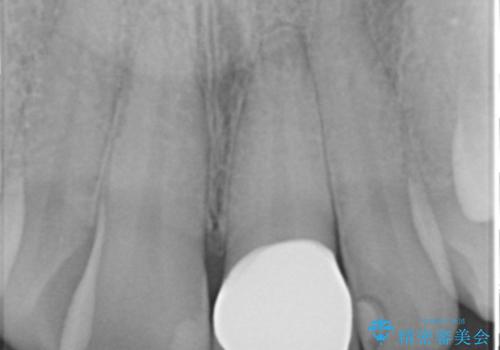 前歯のつめもの きれいにしたい 30代男性の治療後