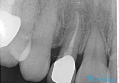 変色した前歯 オーダーメイドタイプのオールセラミッククラウンの治療後