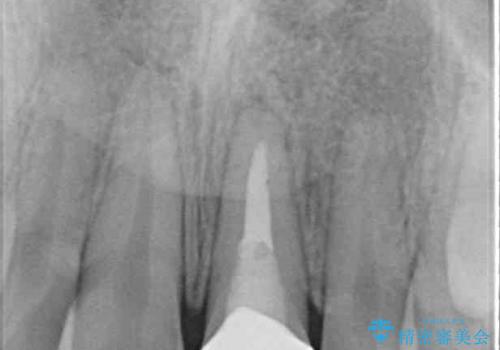 気になる前歯を治したい インビザライン矯正とオールセラミッククラウンの治療後