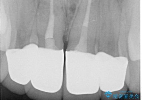 セラミック矯正　気になる前歯の歯並びの改善の治療後