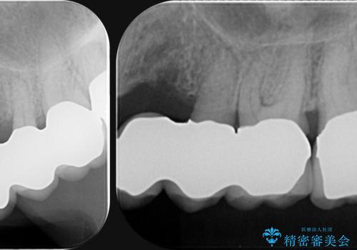 歯周病 側方力に対抗するブリッジ補綴の治療後