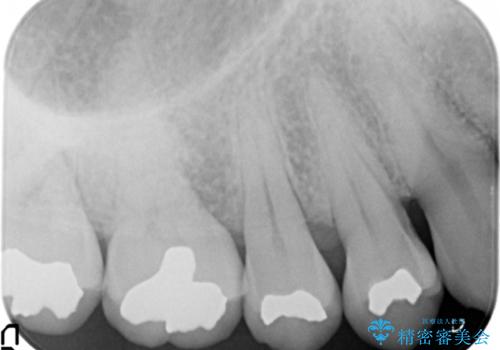 銀歯の引っかかり　化学的に安定したゴールドインレー修復の治療後