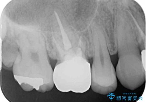 変色した前歯 オーダーメイドタイプのオールセラミッククラウンの治療後