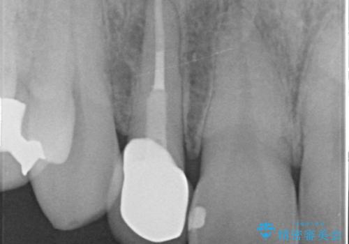 オールセラミッククラウン メタルフリーのクラウンへの治療後
