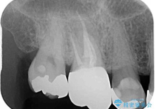 痛む奥歯 セラミッククラウンによるむし歯治療の治療後