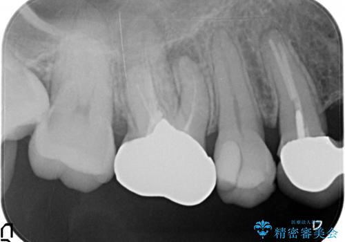 オールセラミッククラウン 他院にて治療困難と言われた歯の治療の治療前