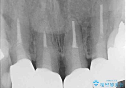 汚れてしまった保険のクラウン 前歯のオールセラミックの治療後