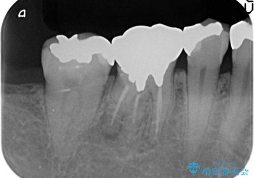オールセラミッククラウン 他院にて根管治療を勧められた歯の治療の治療前