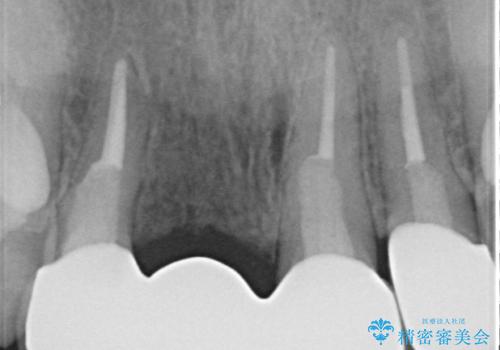 オールセラミッククラウン 折れてしまった前歯の治療の治療後