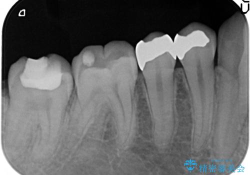 セラミックインレー　銀歯を白い歯への治療前