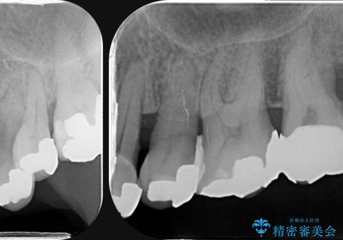 歯周病 側方力に対抗するブリッジ補綴の治療前