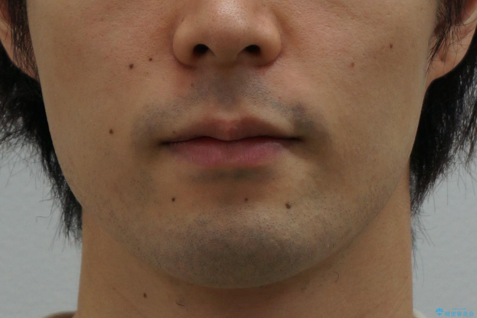 前歯のがたつき・すれちがい咬合を非抜歯で。流行の、格安マウスピースでは難しい、ワンランク上の治療の治療前(顔貌)