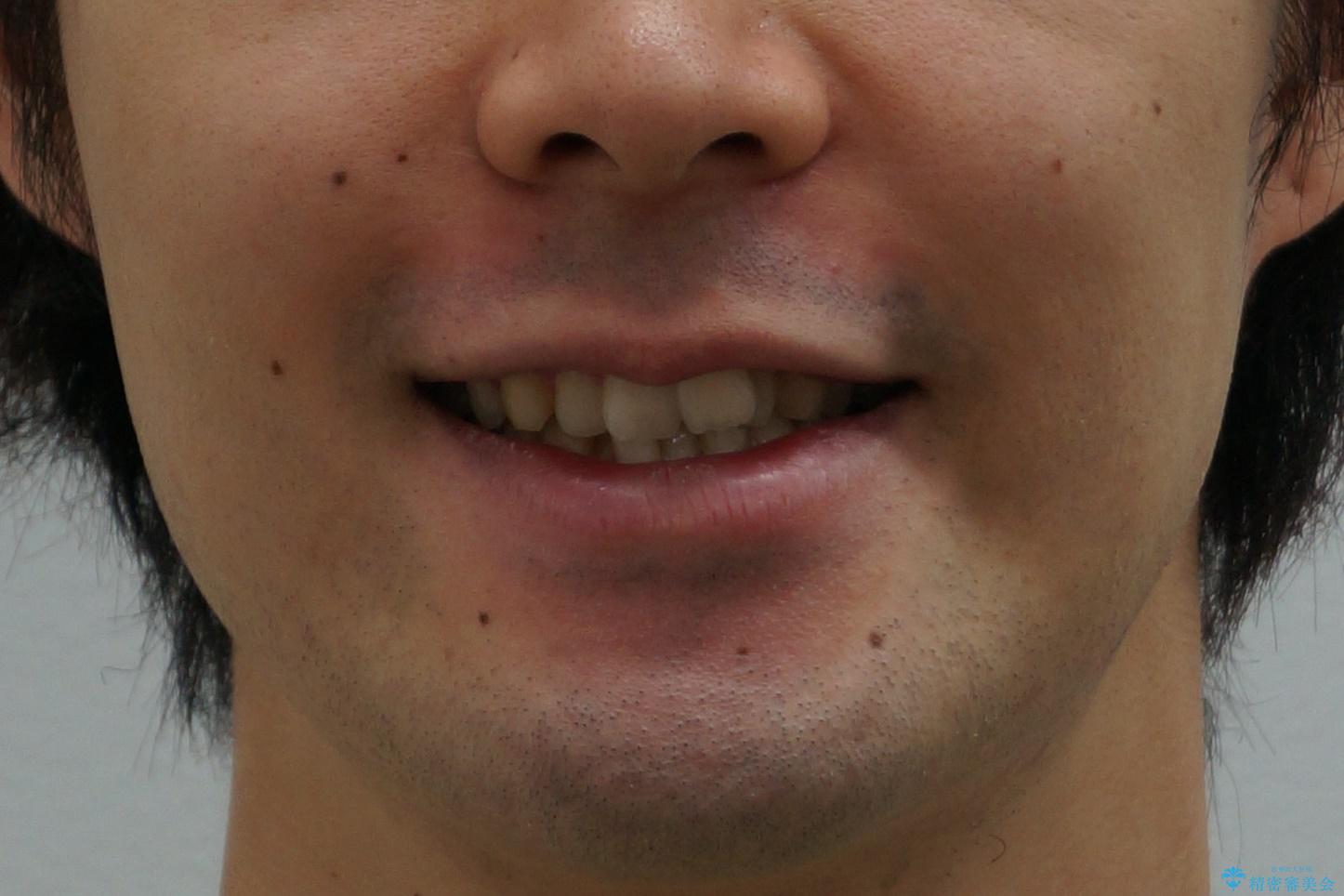 前歯のがたつき・すれちがい咬合を非抜歯で。流行の、格安マウスピースでは難しい、ワンランク上の治療の治療前（顔貌）