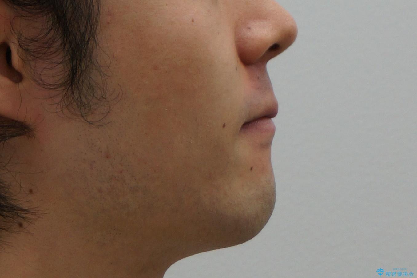 前歯のがたつき・すれちがい咬合を非抜歯で。流行の、格安マウスピースでは難しい、ワンランク上の治療の治療前(顔貌)