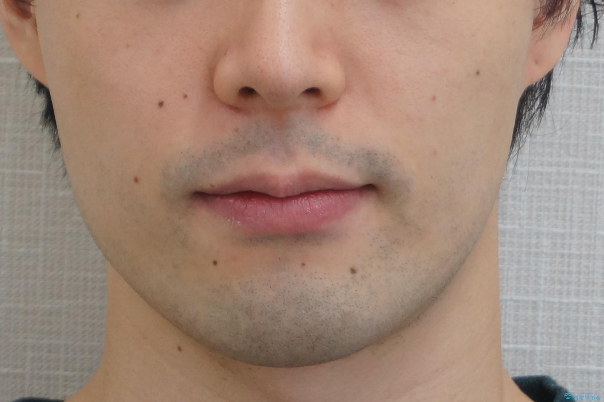 前歯のがたつき・すれちがい咬合を非抜歯で。流行の、格安マウスピースでは難しい、ワンランク上の治療の治療後(顔貌)