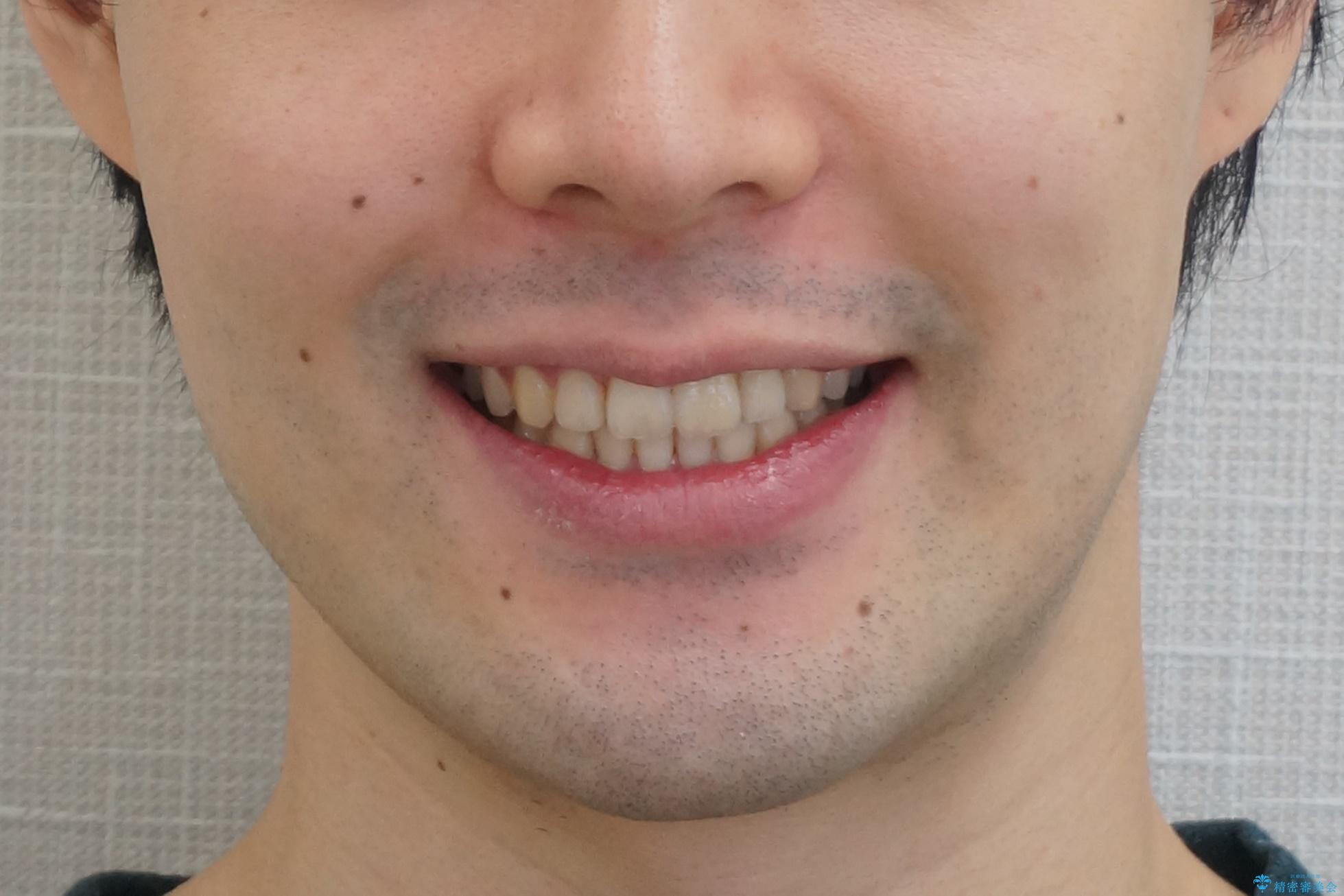 前歯のがたつき・すれちがい咬合を非抜歯で。流行の、格安マウスピースでは難しい、ワンランク上の治療の治療後（顔貌）