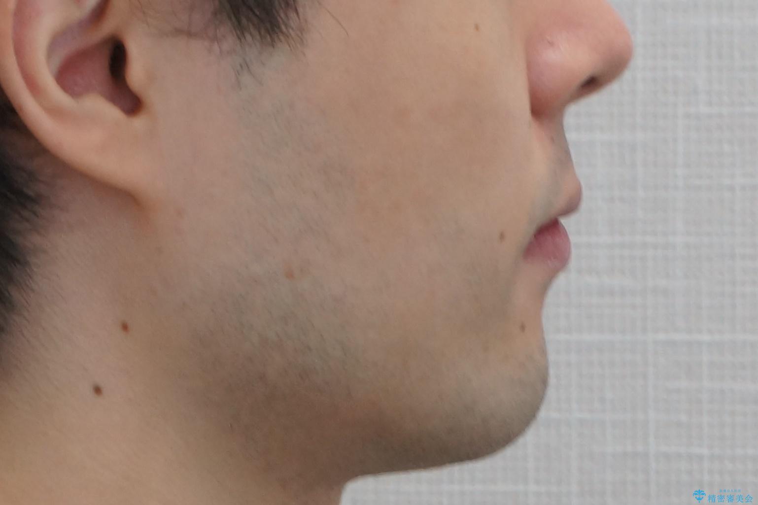 前歯のがたつき・すれちがい咬合を非抜歯で。流行の、格安マウスピースでは難しい、ワンランク上の治療の治療後(顔貌)