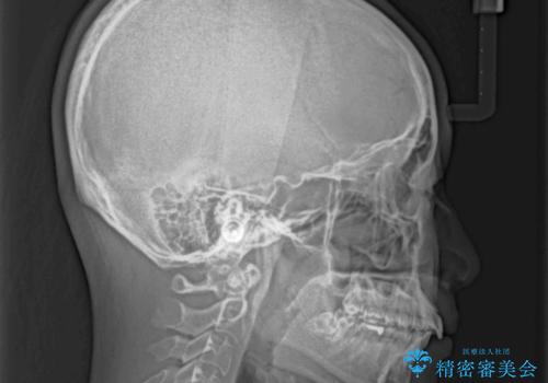 気になる前歯を治したい インビザライン矯正とオールセラミッククラウンの治療前