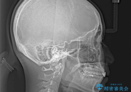 気になる前歯を治したい インビザライン矯正とオールセラミッククラウンの治療後