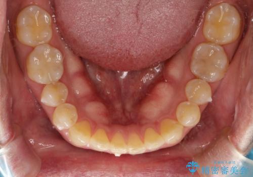 前歯の真ん中の隙間を閉じたい　インビザラインによる目立たない矯正の治療中
