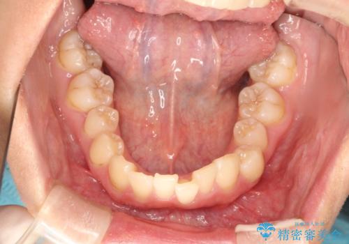 前歯の突出、深い噛み合わせ、ガタつきをマウスピース矯正(インビザライン)で治療した症例の治療前