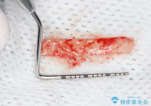 徐々に下がってきた歯肉へ再生療法(歯冠側移動術と結合組織移植術の併用)を施術し、丈夫な歯肉を獲得させた症例の治療前