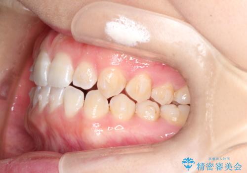 前歯の隙間を閉じたい　インビザラインによる矯正の治療中