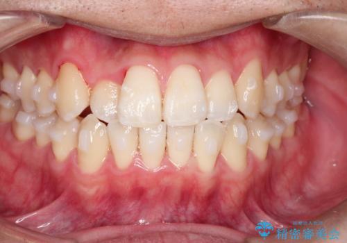 前歯のクロスバイトとガタつきをマウスピース矯正(インビザライン )で治療した症例の治療中