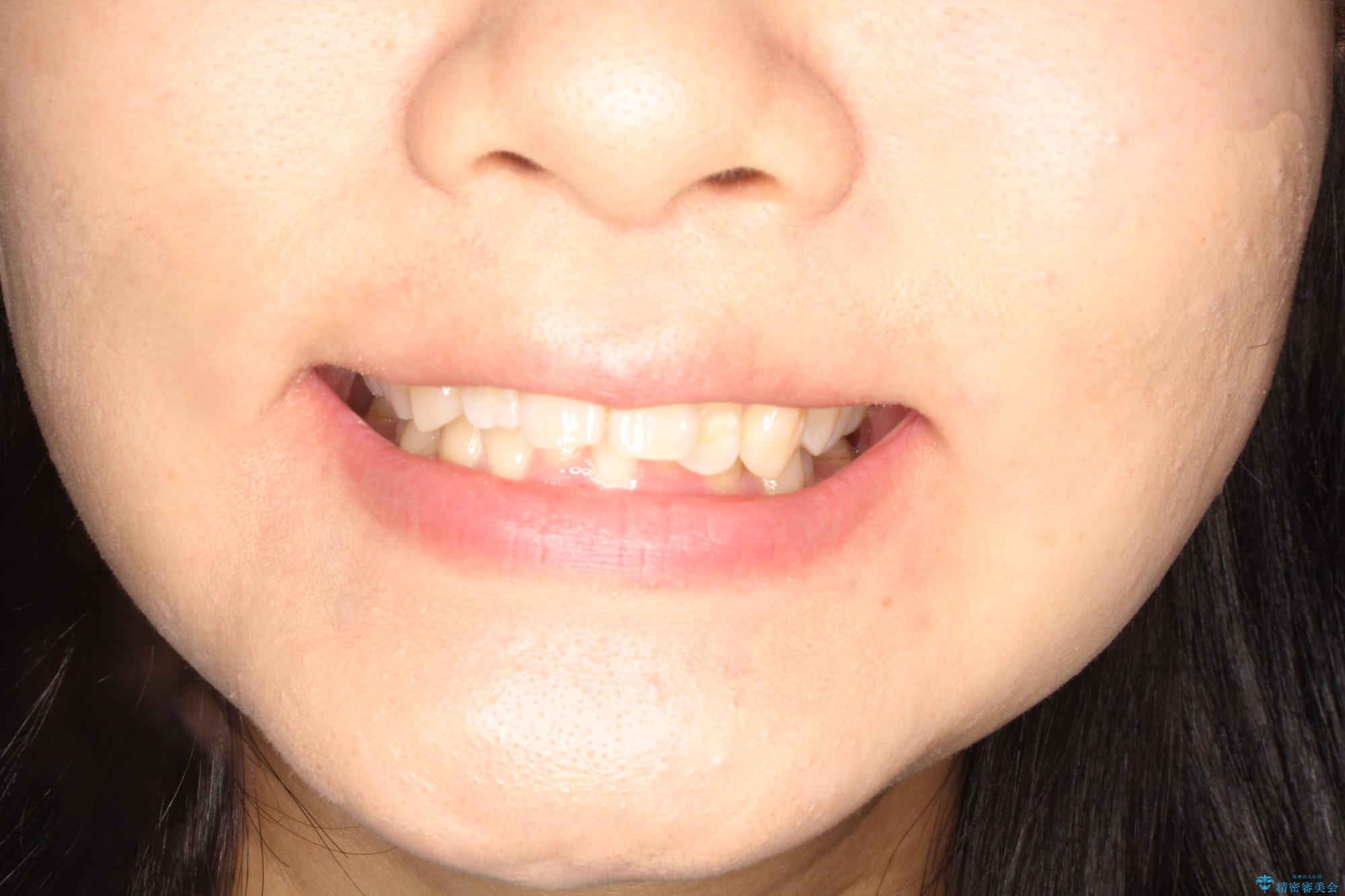 前歯の突出、深い噛み合わせ、ガタつきをマウスピース矯正(インビザライン)で治療した症例の治療前（顔貌）