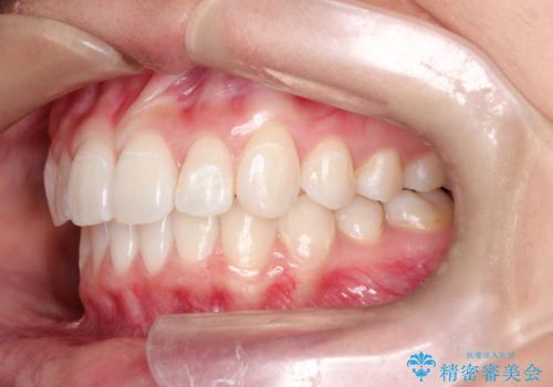 前歯の突出、深い噛み合わせ、ガタつきをマウスピース矯正(インビザライン)で治療した症例の治療後